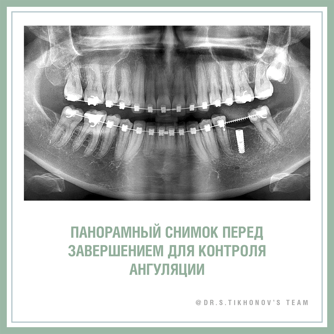 10 советов по закрытию большой диастемы от Сергея Тихонова.