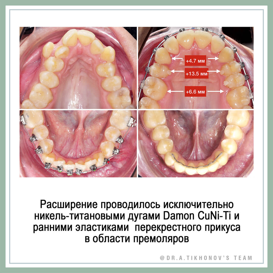 Зубоальвеолярное расширение