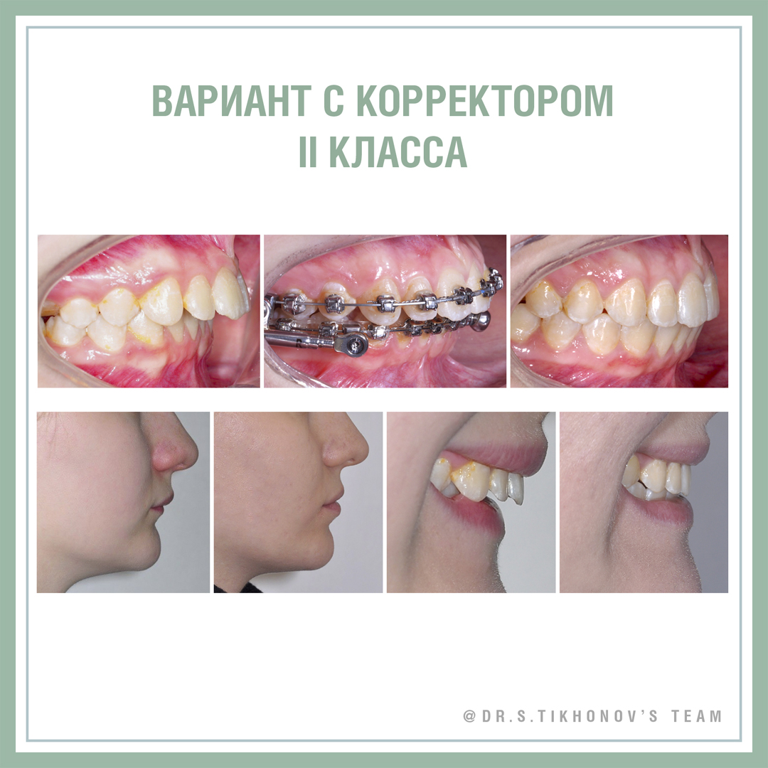 Вариант с корректором II класса