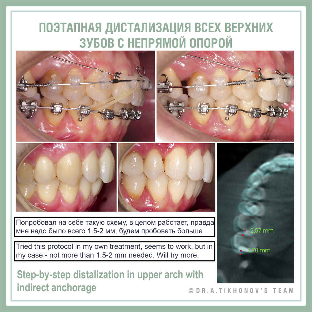 Поэтапная дистализация всех верхних зубов с непрямой опорой