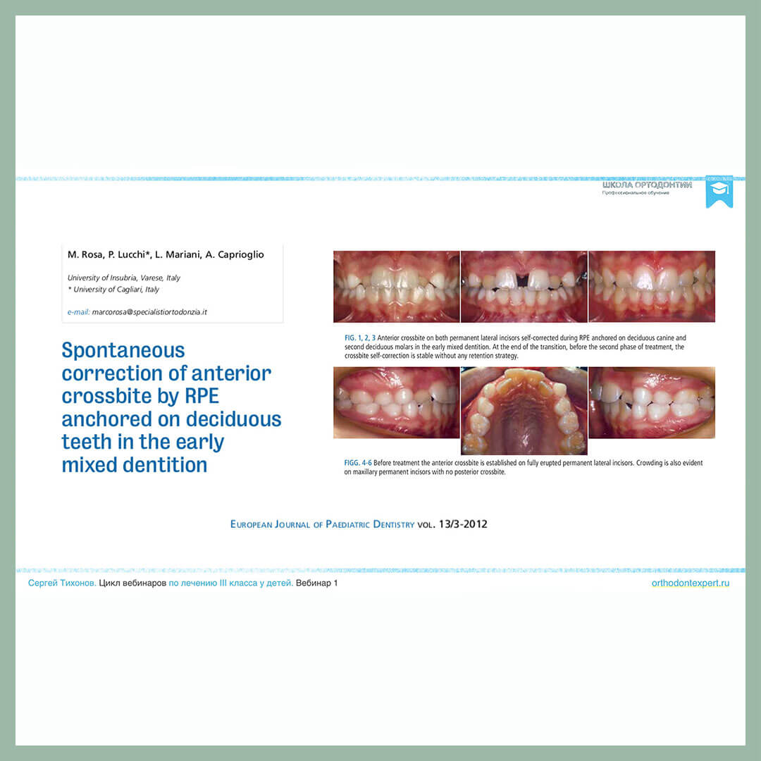 Спонтанная коррекция переднего перекрестного прикуса с помощью ретейнеров, закрепленных на молочных зубах в раннем смешанном прикусе