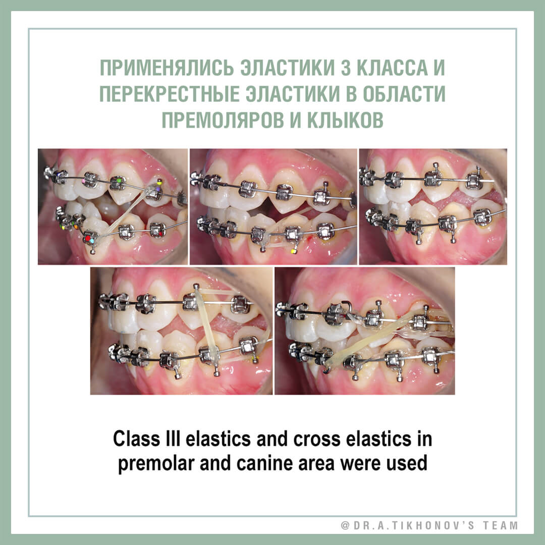 Применялись эластики 3 класса и перекрестные эластики в области премоляров и клыков
