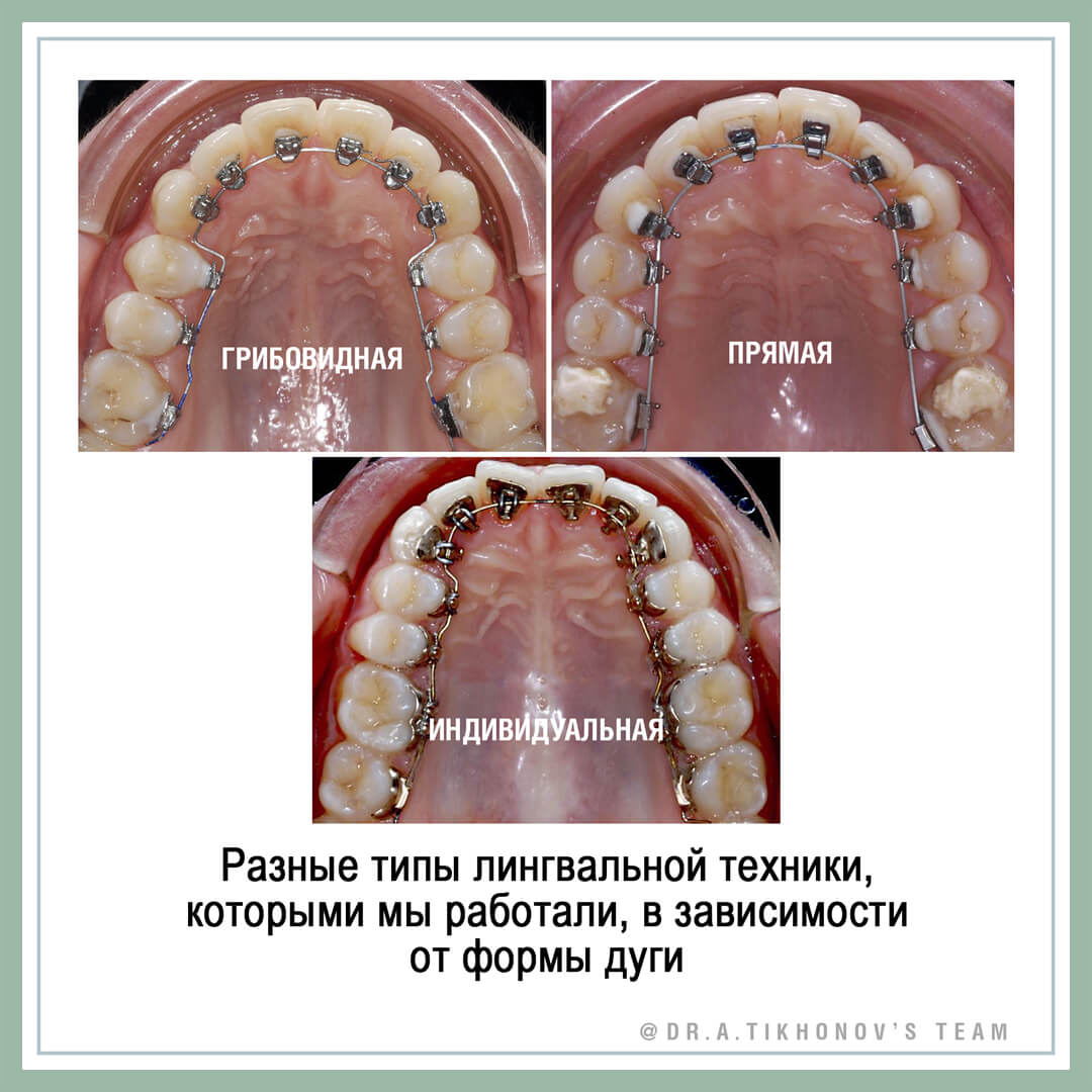 Разные типы лингвальной техники, которыми мы работали, в зависимости от формы дуги