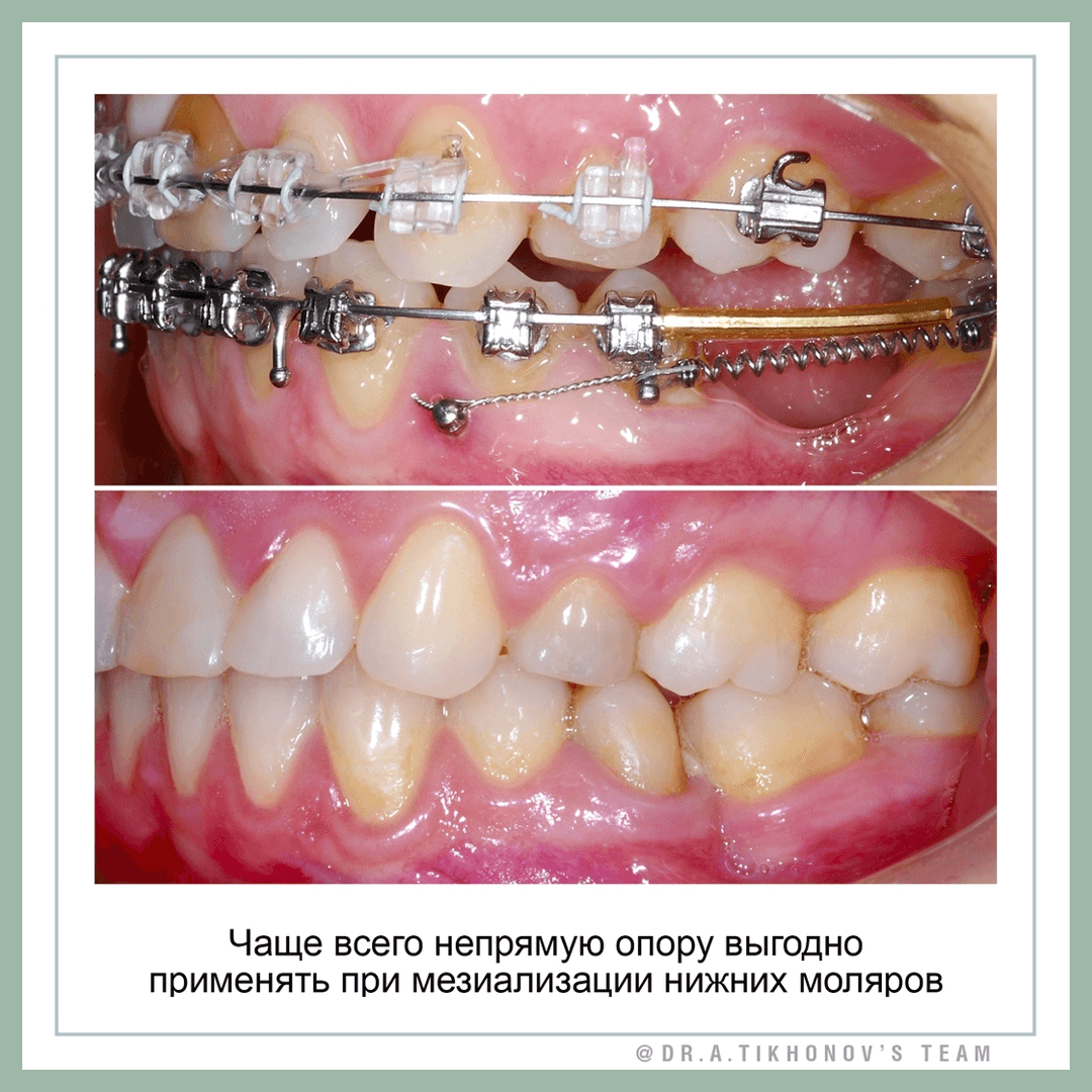 Чаще всего непрямую опору выгодно применять при мезиализации нижних моляров