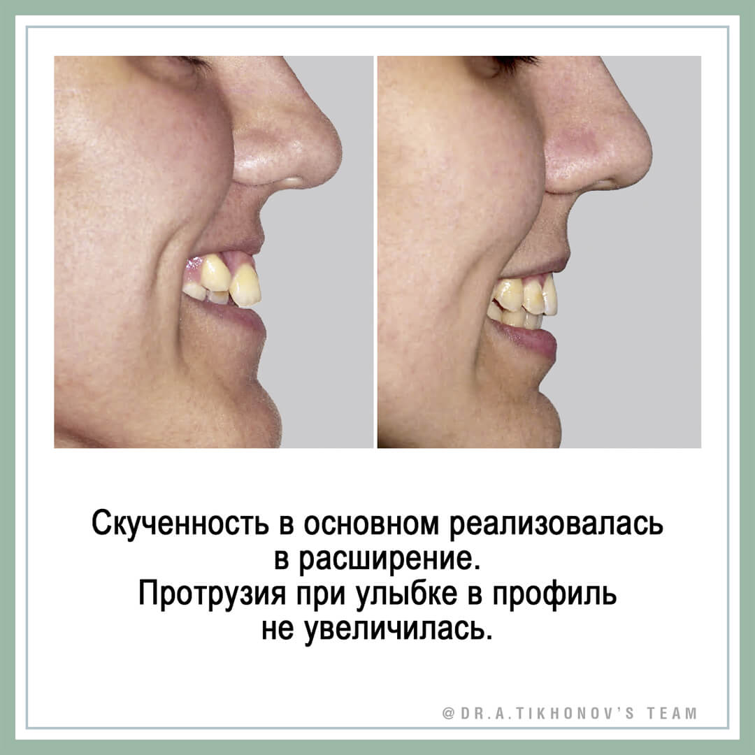 Скученность в основном преобразовалась в расширение. Протрузия при улыбке в профиль не увеличилась.