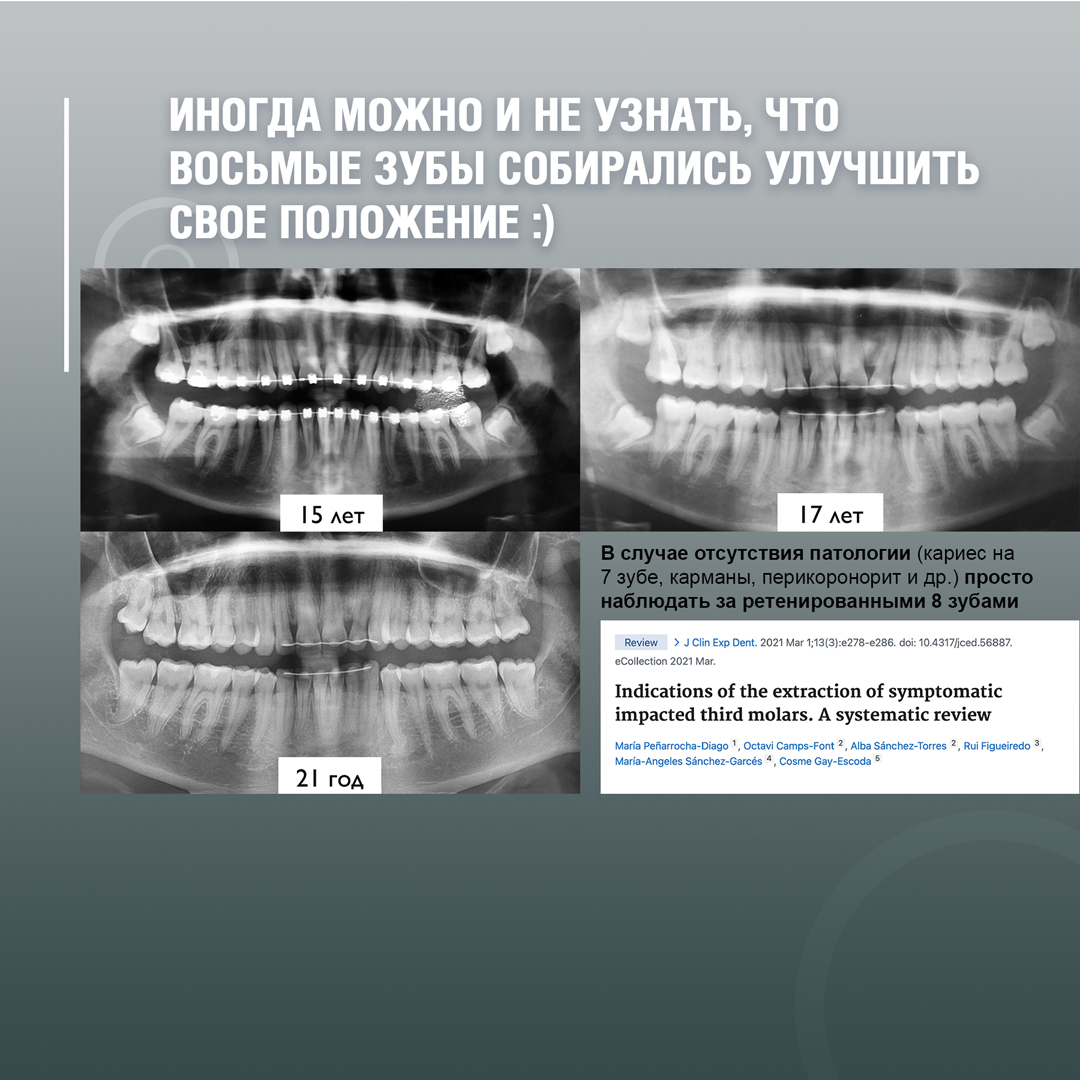 Иногда можно и не узнать, что восьмые зубы собирались улучшить свое положение