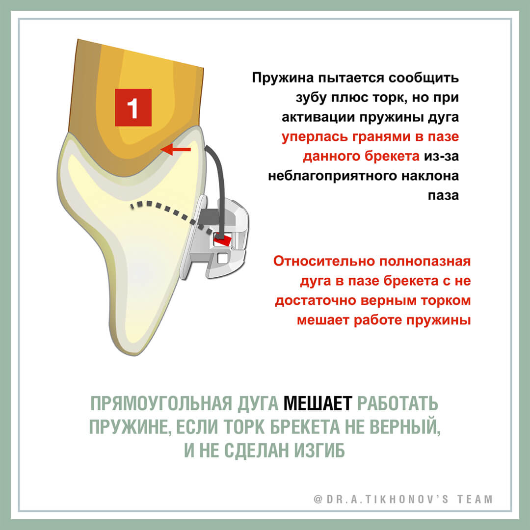 Туманные вопросы ортодонтии. Работают ли торковые пружины?