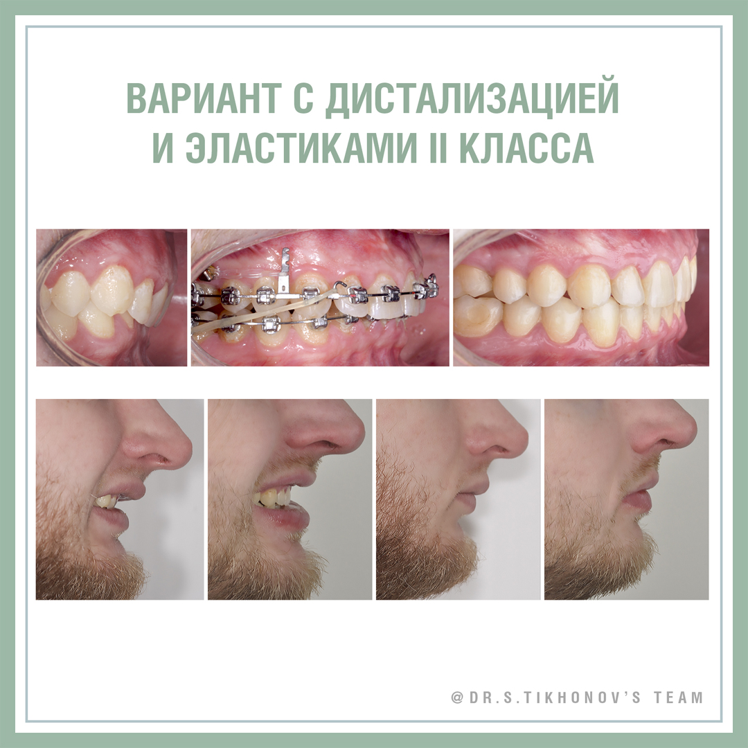 Вариант с дистализацией и корректором II класса