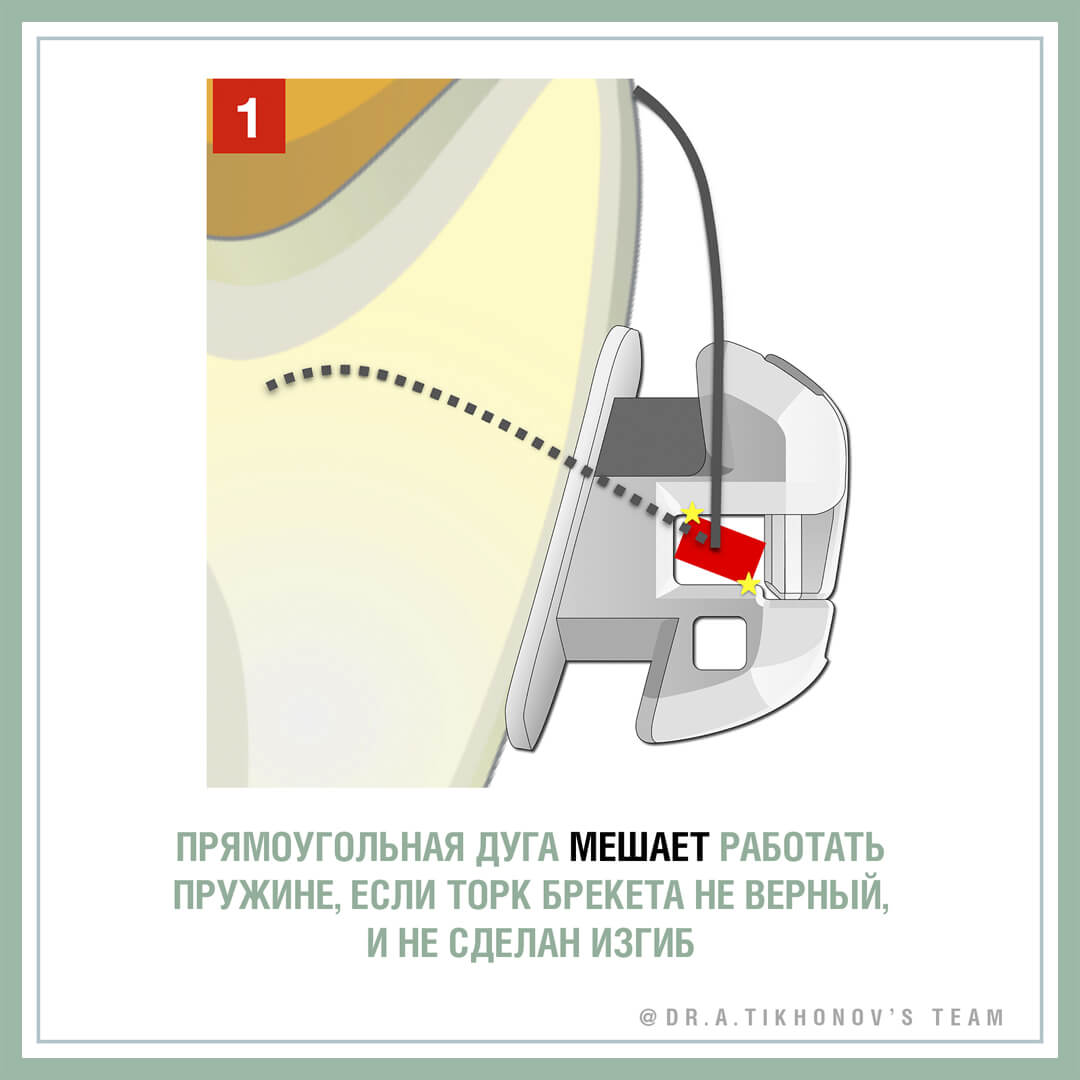 Прямоугольная дуга мешает работать пружине, если торк брекета не верный, и не сделан изгиб