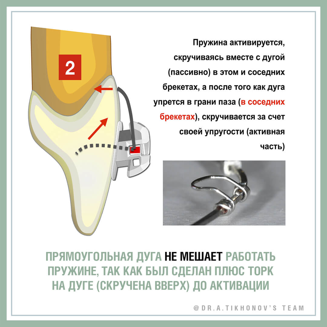 Прямоугольная дуга не мешает работать пружине, так как был сделан плюс торк на дуге (скручена вверх) до активации