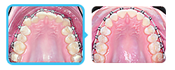 Коррекция скученности зубов брекетами без удаления