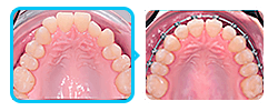 Исправление мезиального прикуса зубов