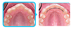 Ортодонтическое лечение  скученности без удаления