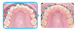 Результат лечения скученности без удаления зубов