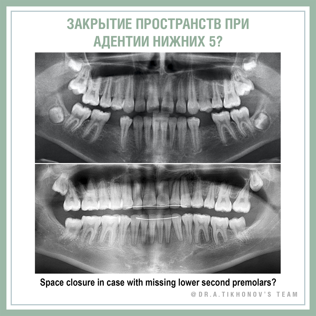 Закрытие пространств при адентии нижних 5?