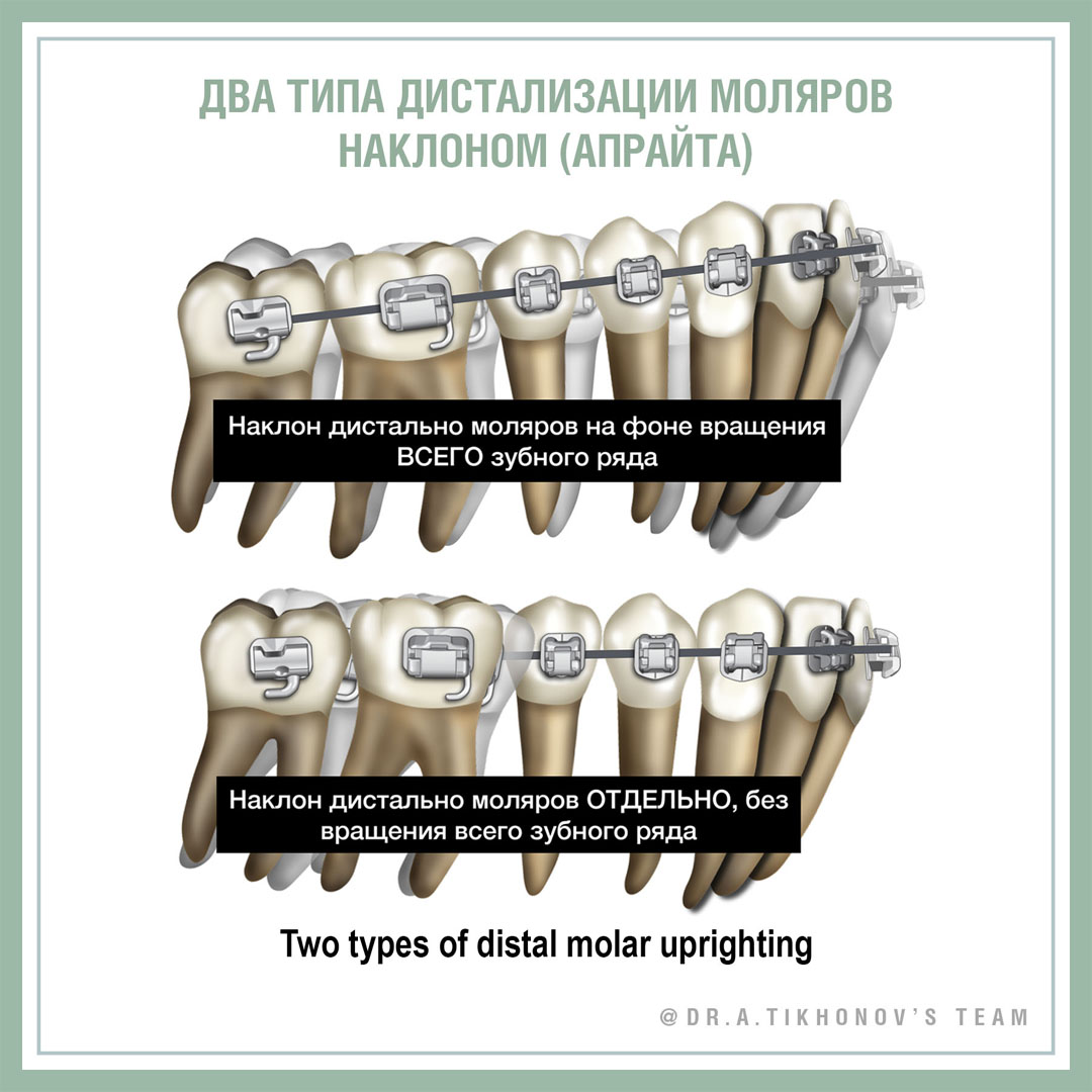 Два типа наклонной дистализации моляров.