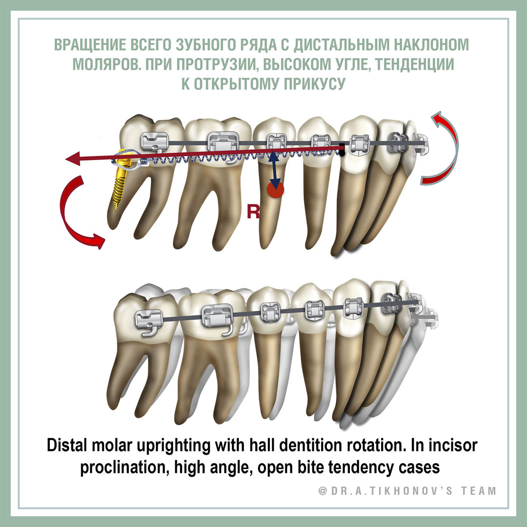 Вращение всего зубного ряда с дистальным наклоном моляров. При протрузии, высоком угле, тенденции к открытому прикусу
