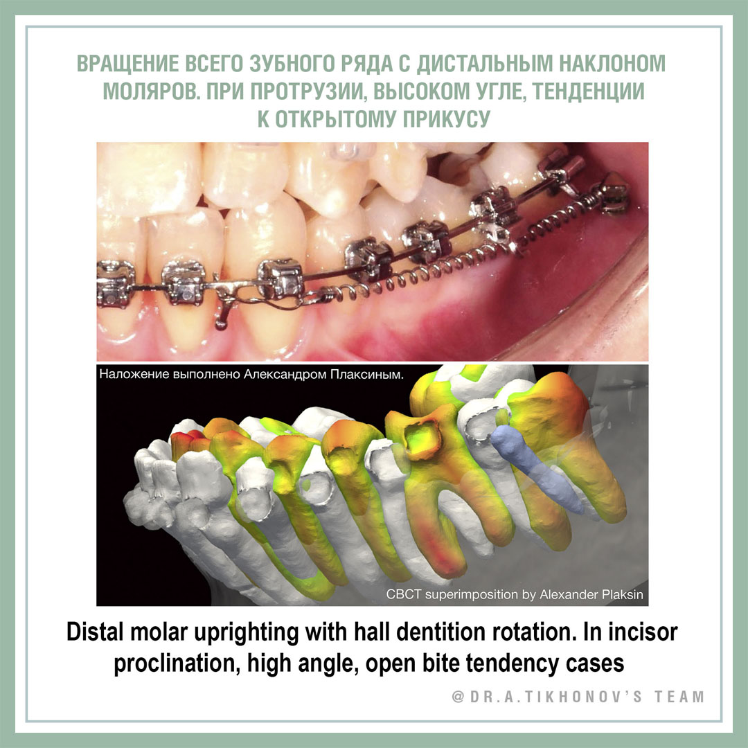 Вращение всего зубного ряда с дистальным наклоном моляров