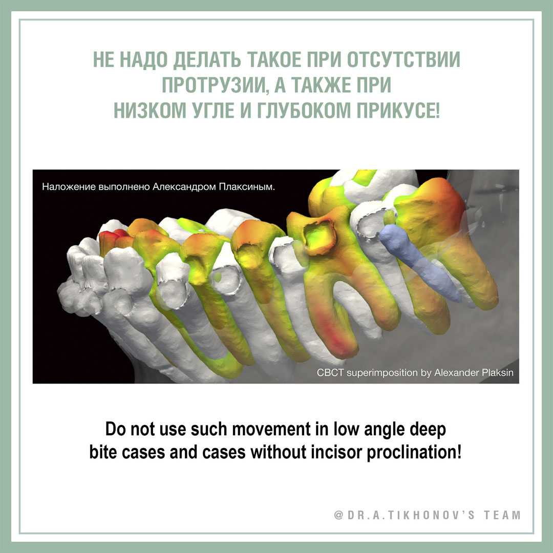 Не надо делать такое при отсутствии протрузии, а так же при низком угле и глубоком прикусе