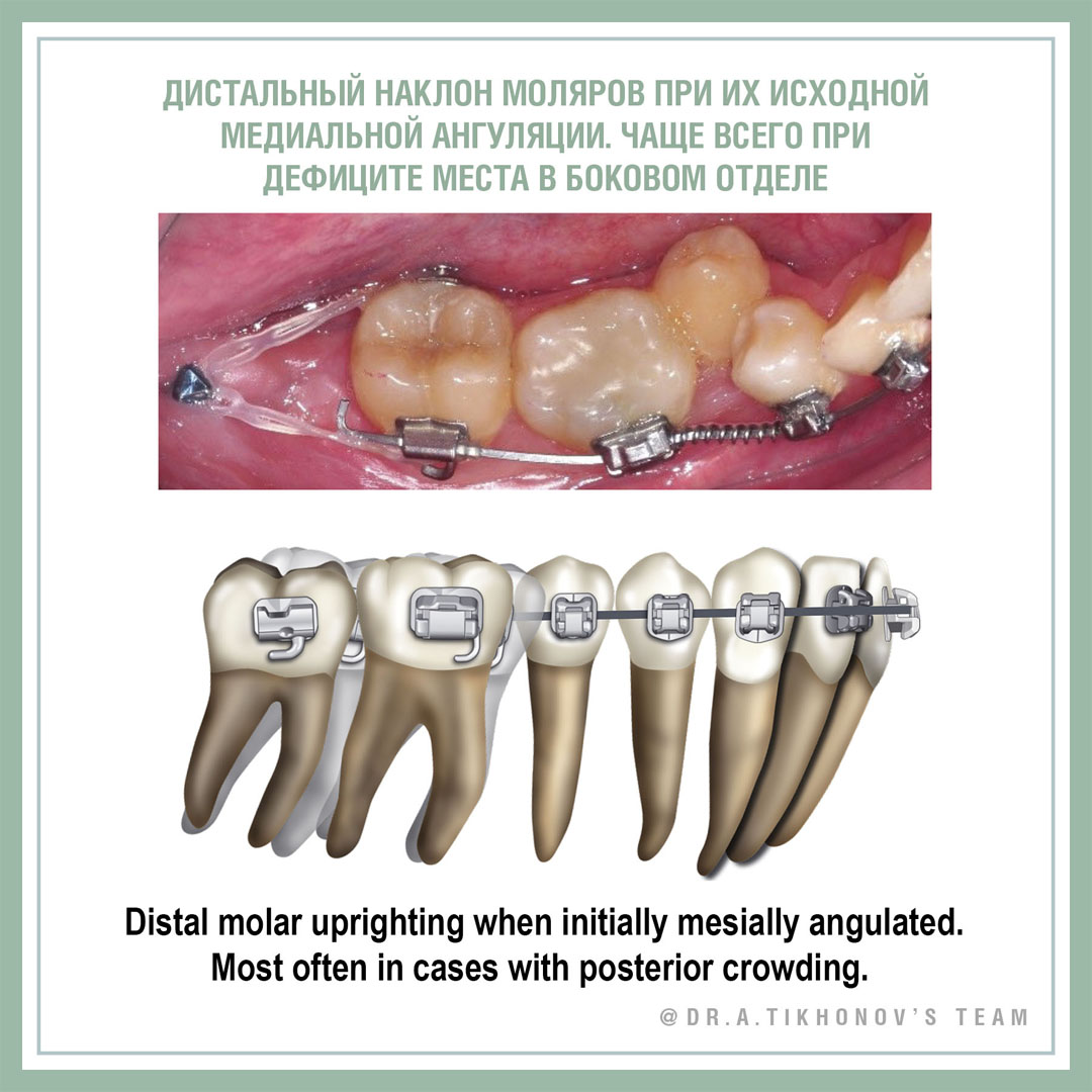 Дистальный наклон моляров при их исходной медиальной ангуляции