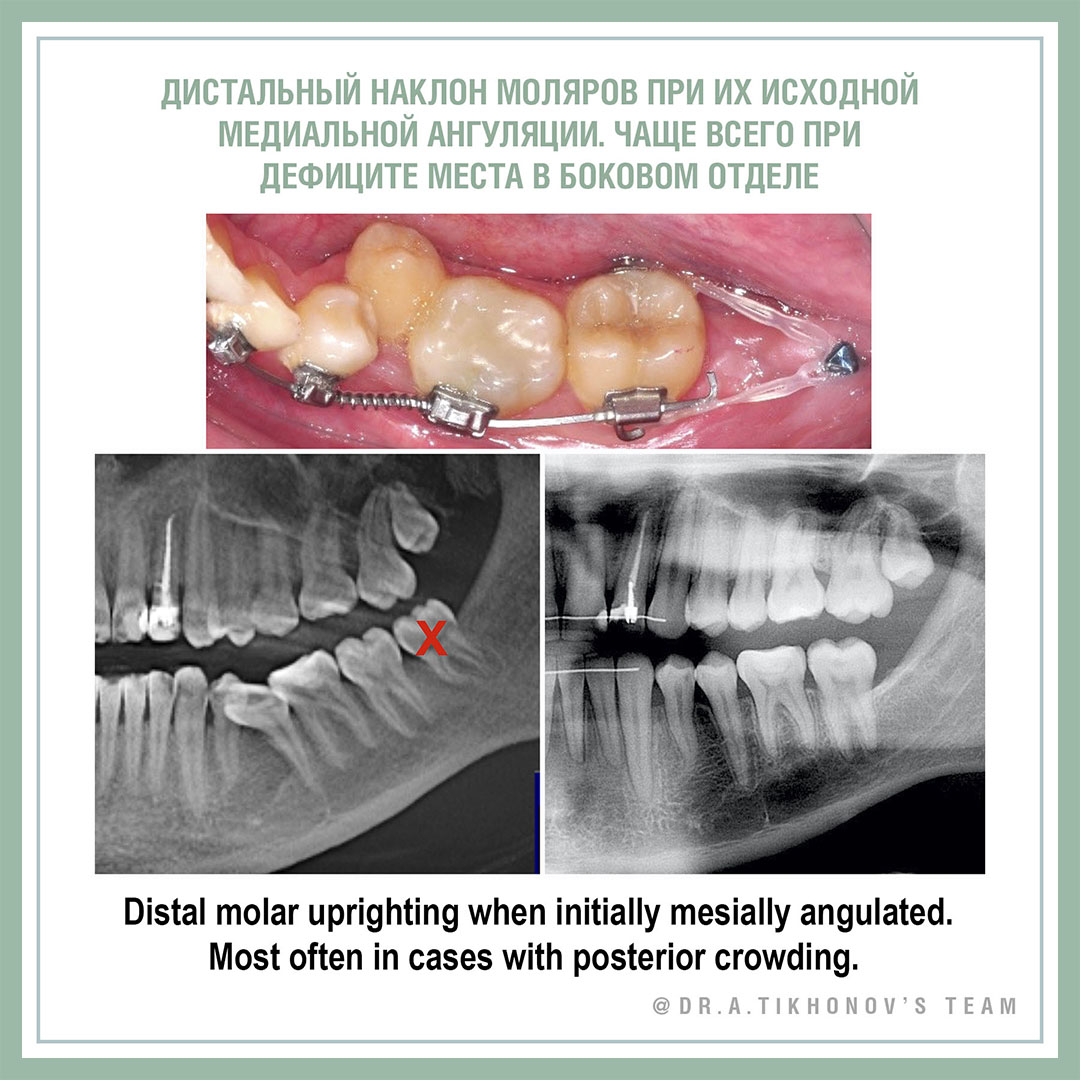 Дистальный наклон моляров при их исходной медиальной ангуляции. Чаще всего при дефиците места в боковом отделе