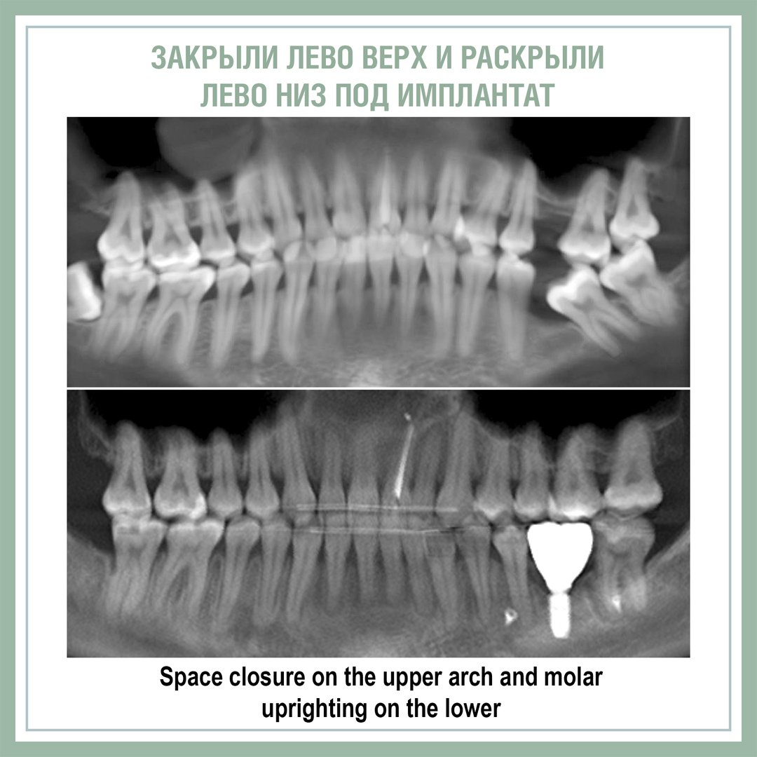 Закрыли лево верх и раскрыли лево низ под имплантат