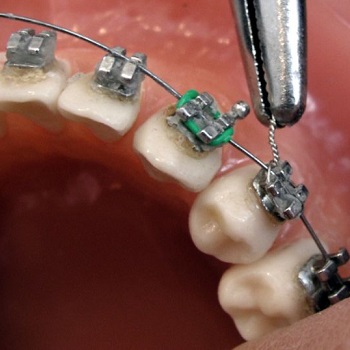 Дуга на брекеты: для чего?