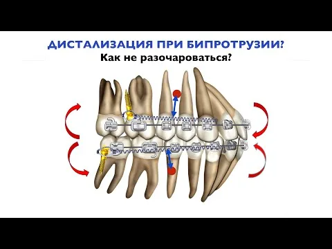 Дистализация при бипротрузии