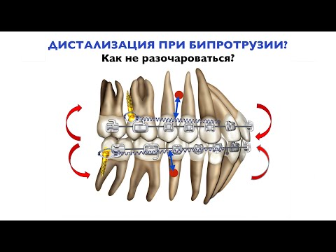 Дистализация при бипротрузии.