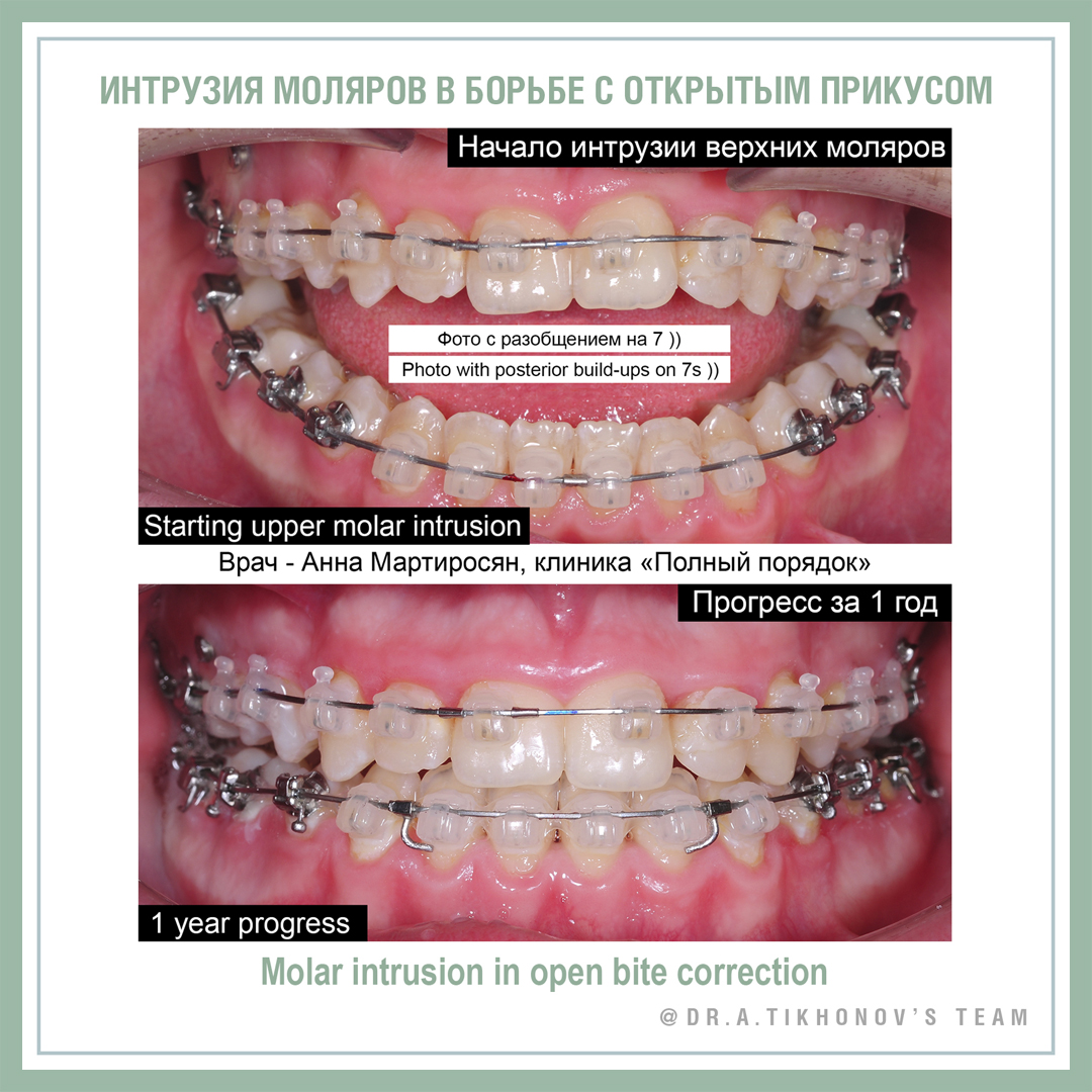 Интрузия моляров в борьбе с открытым прикусом