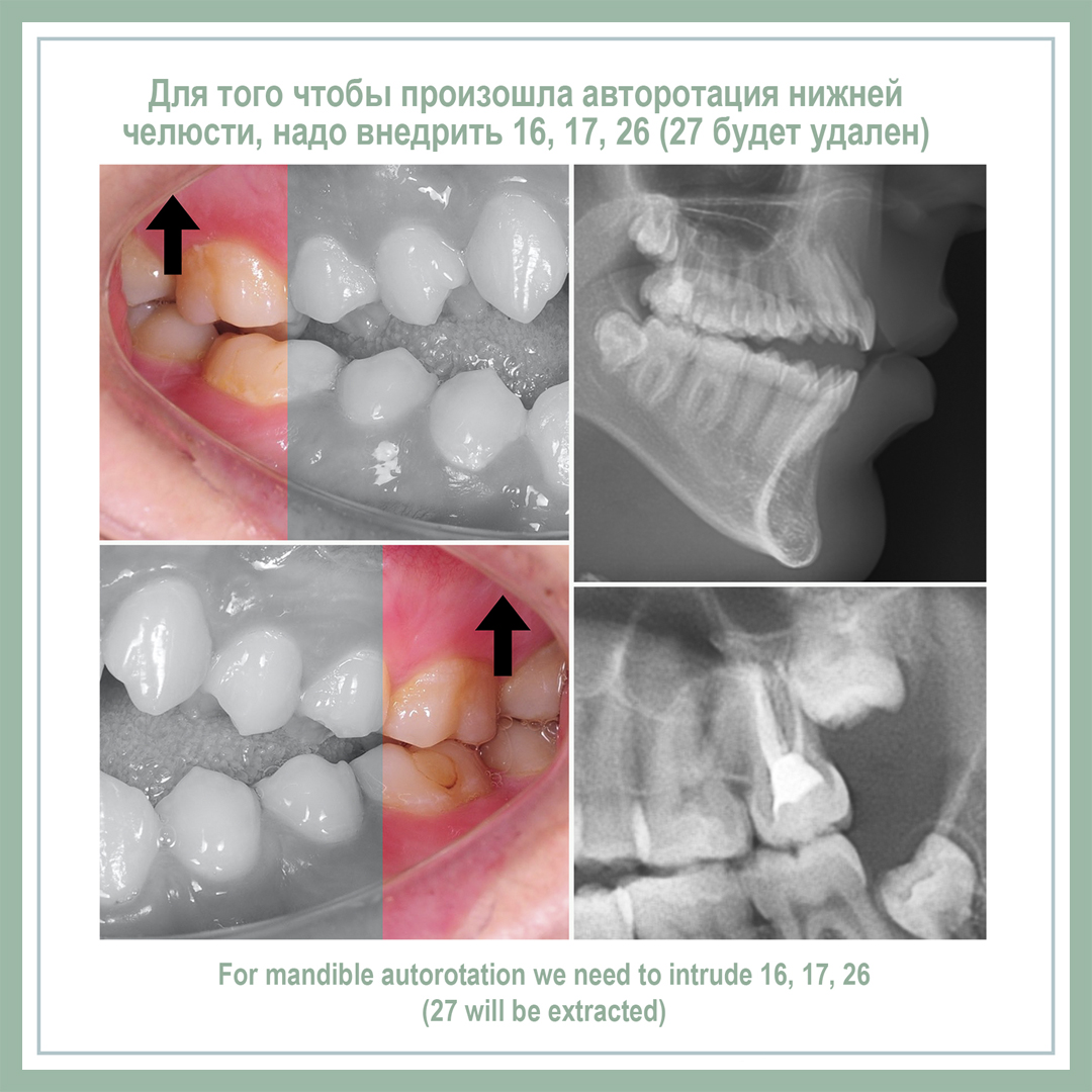 Для того, чтобы произошла авторотация нижней челюсти, надо внедрить 16, 17, 26 (27 будет удален)