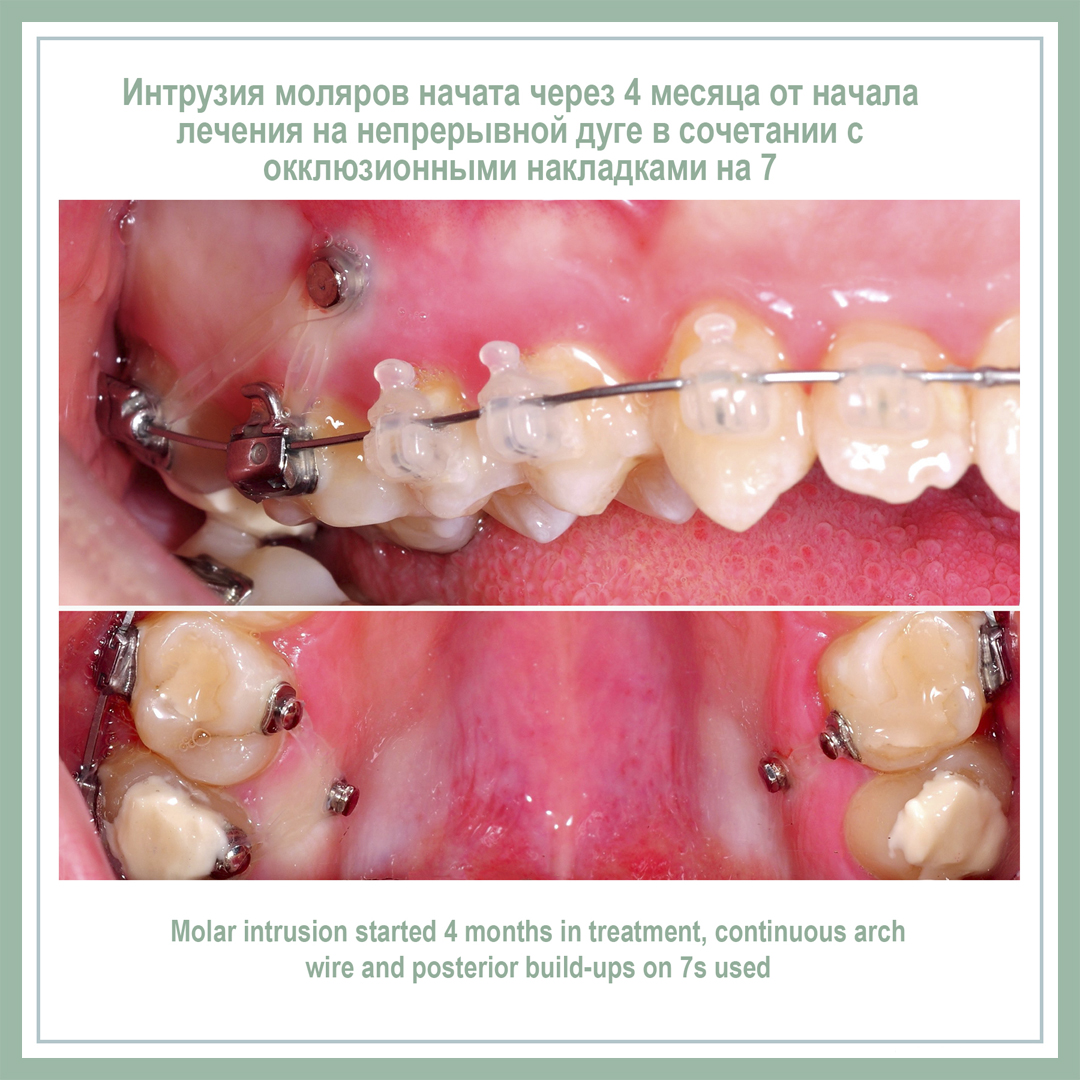 Интрузия моляров начата через 4 месяца от начала лечения на непрерывной дуге в сочетании с окклюзионными накладками на 7