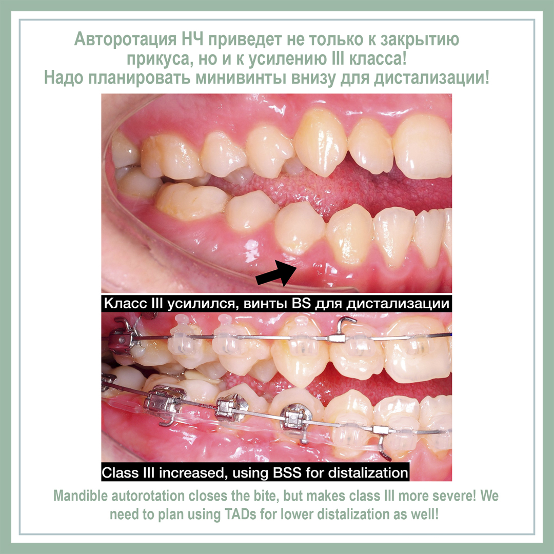 Авторотация НЧ приведет не только к закрытию прикуса, но и к усилению 3 класса