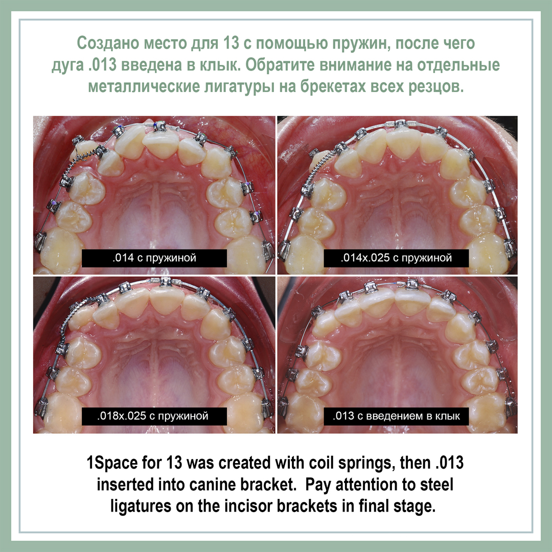 Создано место для 13 с помощью пружин, после чего дуга .013 введена в клык. Обратите внимание на отдельные металлические лигатуры на брекетах всех резцов.