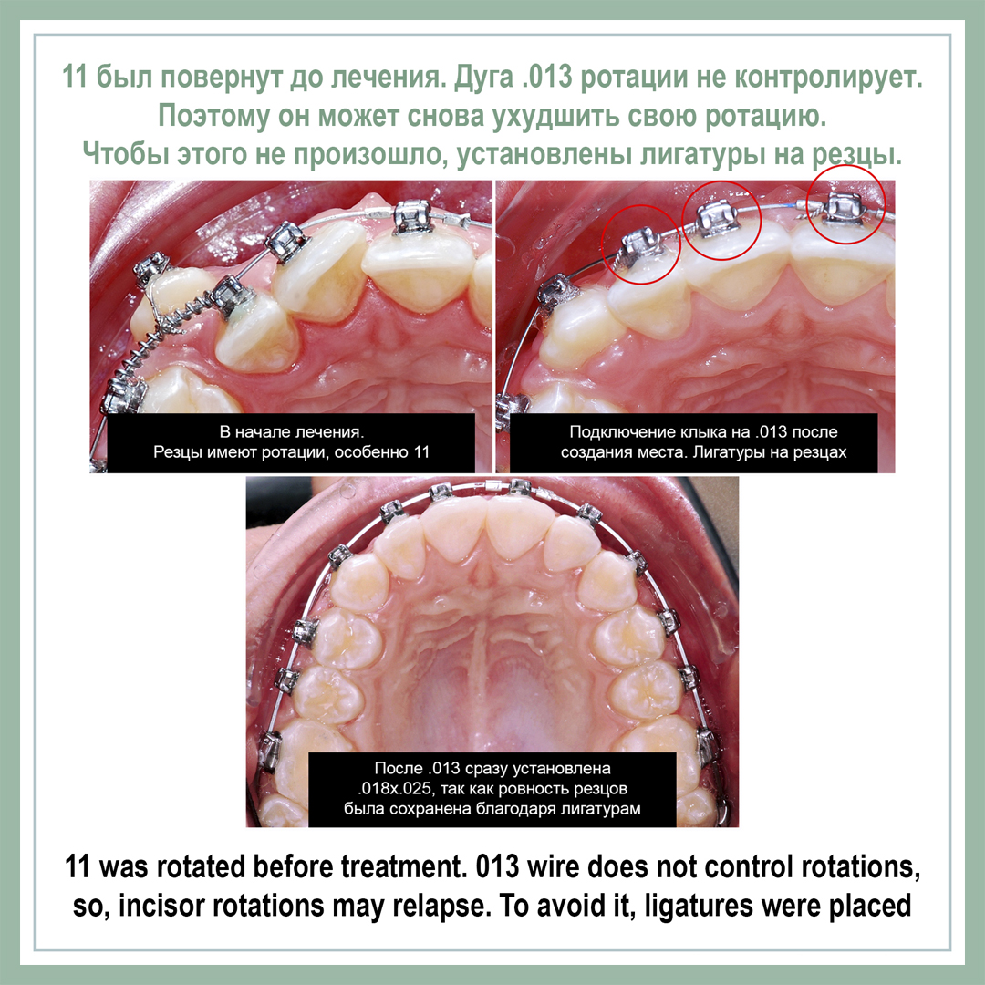 11 был повернут до лечения. Дуга .013 ротации не контролирует. Поэтому он может снова ухудшить свою ротацию. Чтобы этого не произошло, установлены лигатуры на резцы.