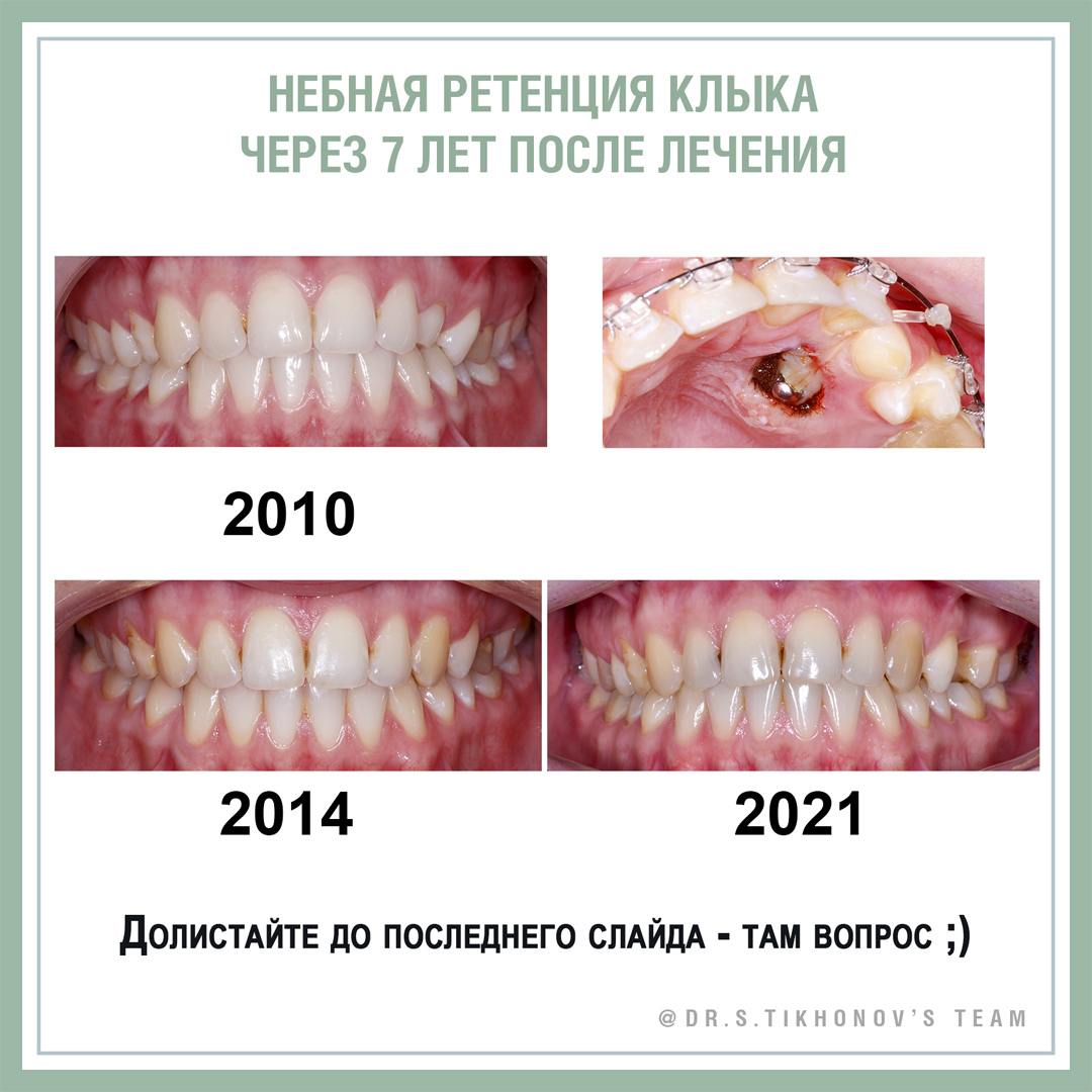 Небная ретенция клыка через 7 лет после лечения.