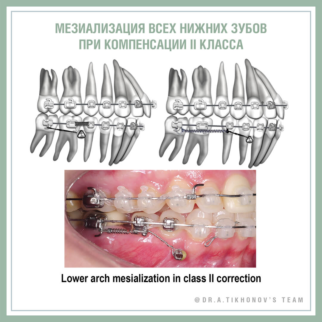 Мезиализация всех нижних зубов при компенсации II класса