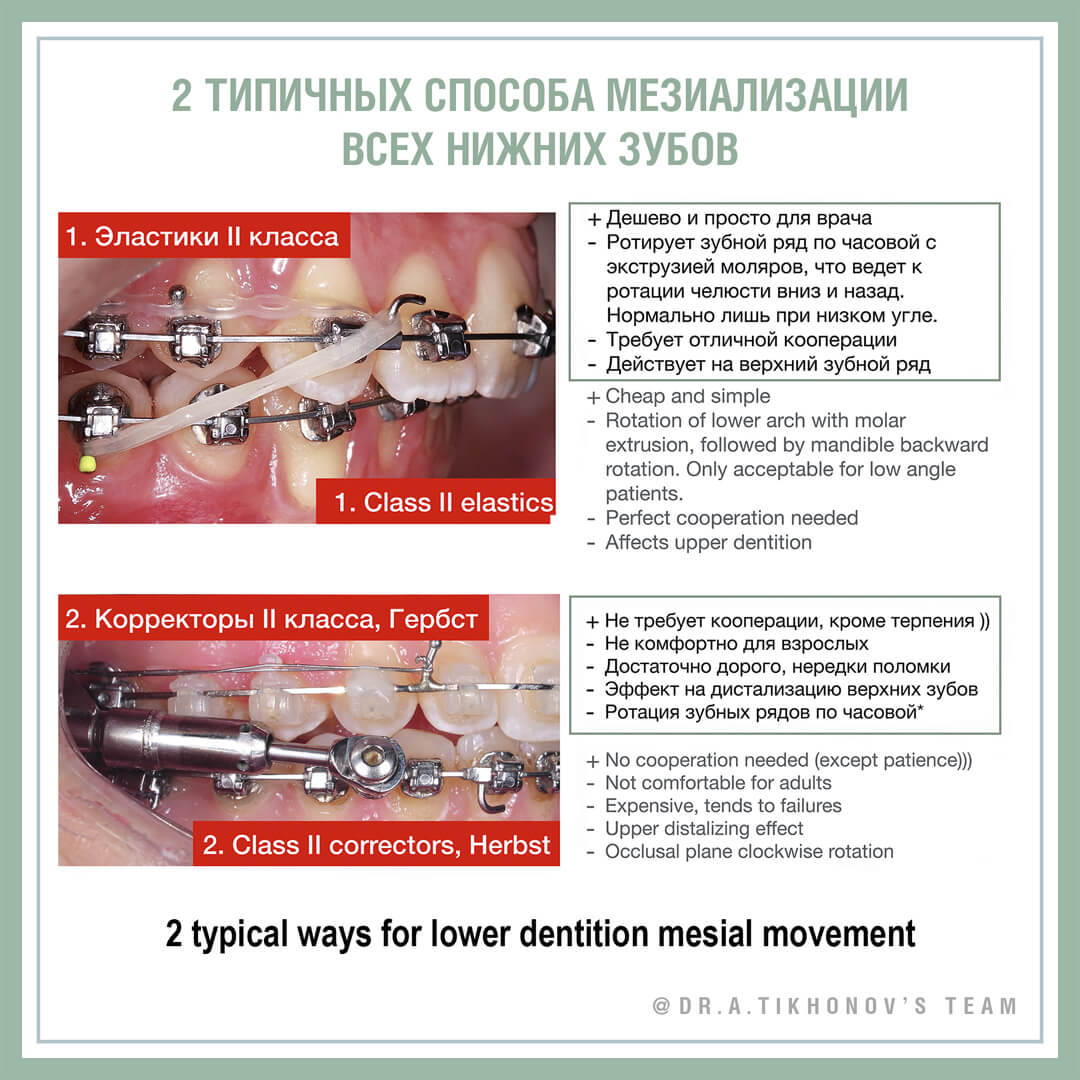 2 типичных способа мезиализации всех нижних зубов