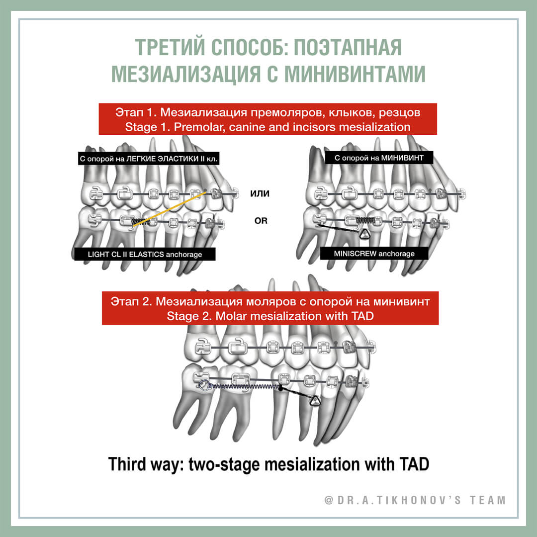 Мезиализация всех нижних зубов при компенсации II класса