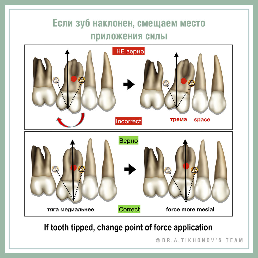 Если зуб наклонен, смещаем место приложения силы