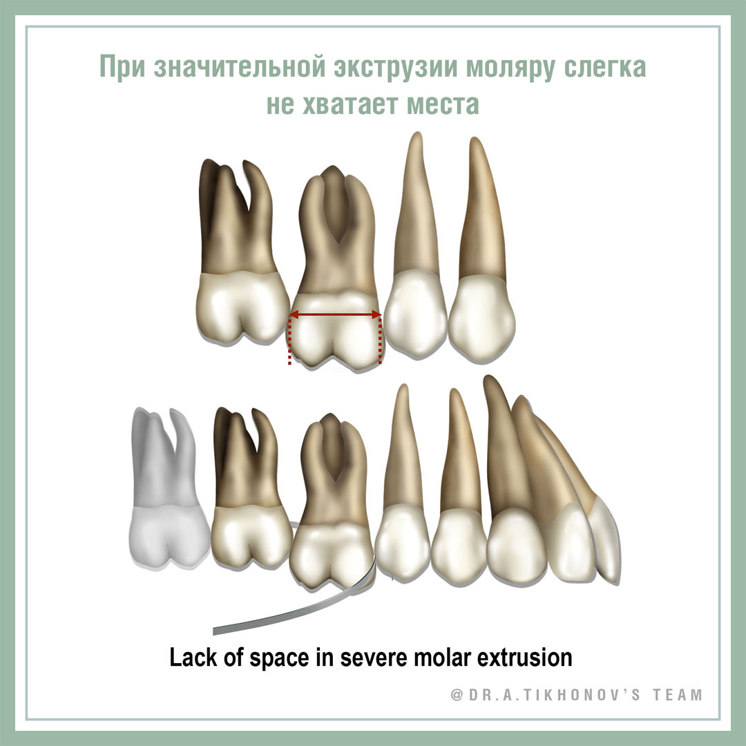 При значительной экструзии моляру слегка не хватает места