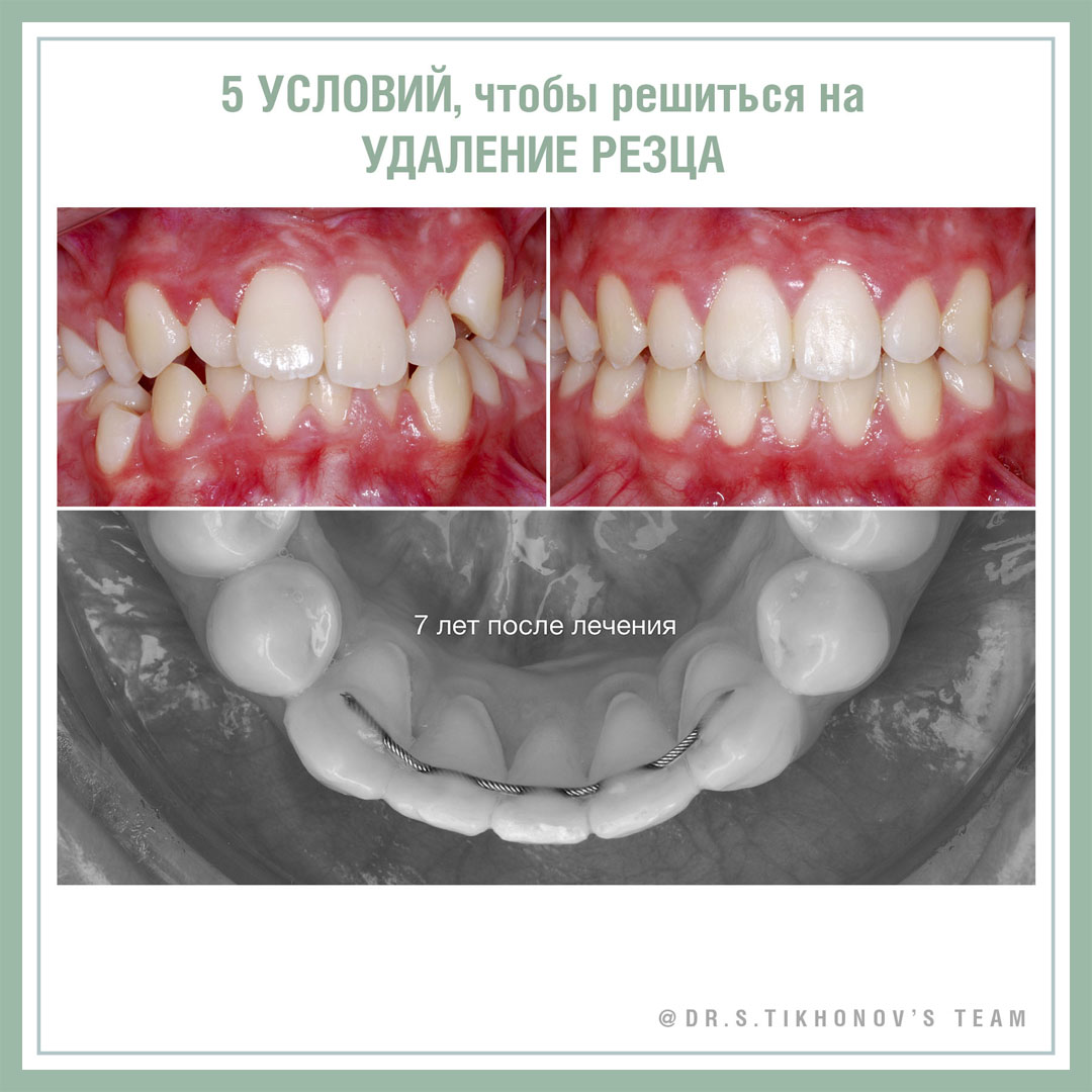 Сергей Тихонов – 5 условий, чтобы решиться на удаление резца!