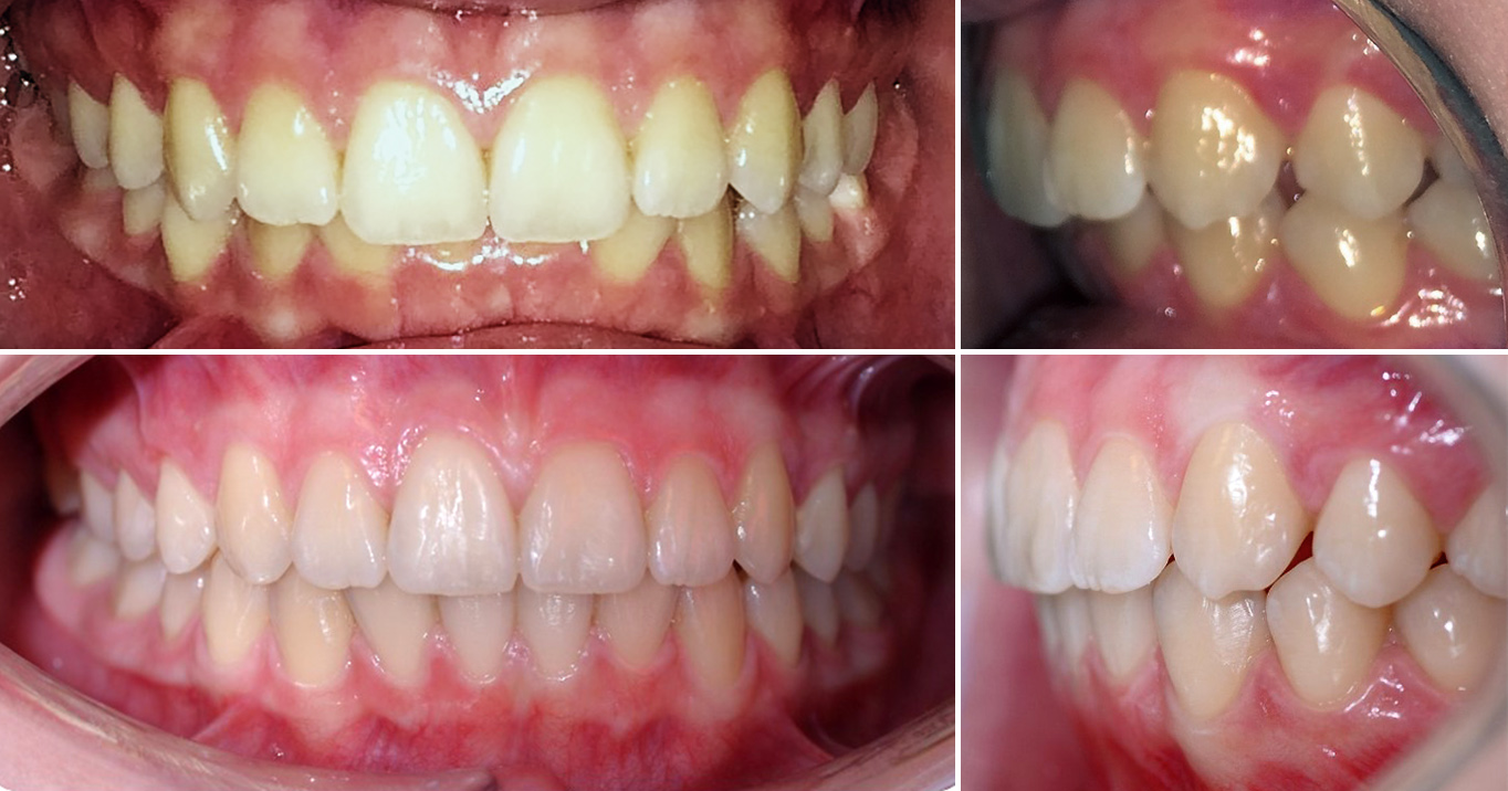 Выравнивание зубов без брекетов: возможно ли это?