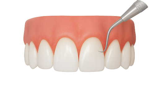 Закрытие рецессии