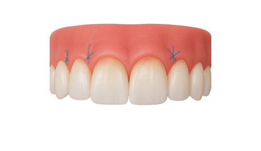Закрытие рецессии