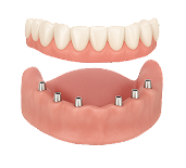 Имплантация при полном отсутствии зубов