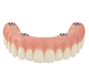 Протезирование по протоколу на 4