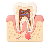Удаление кисты (цистэктомия)