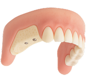 Синус лифтинг