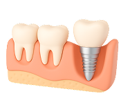 Имплантация после удаления зуба